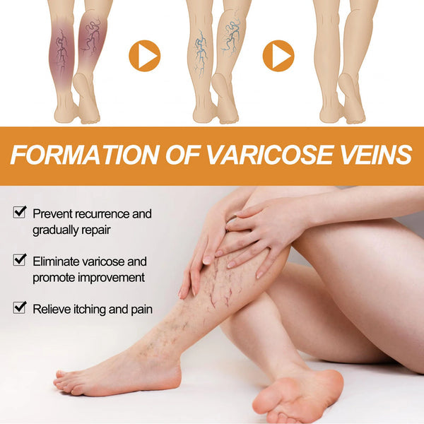 🌿 Varicose Vein Relief Spray – Soothing Comfort in Every Spray! 💧