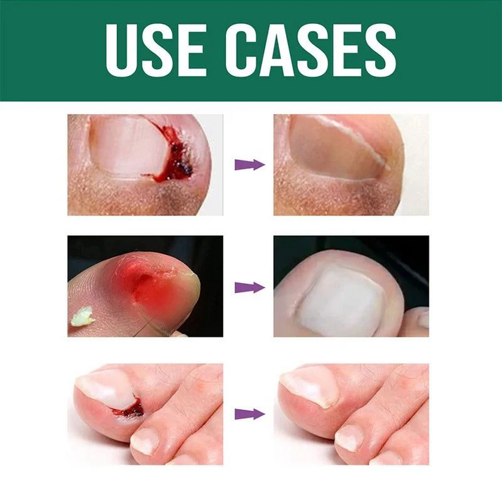 Anti Paronychia Relief Oil 🌿 - (Buy 1 Get 1 FREE🔥🔥)