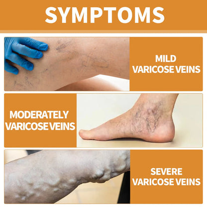🌿 Varicose Vein Relief Spray – Soothing Comfort in Every Spray! 💧