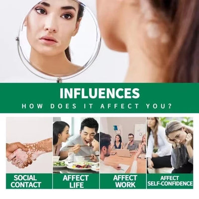 Sumifun Vitiligo Treatment Cream (BUY 1 GET 1 FREE)