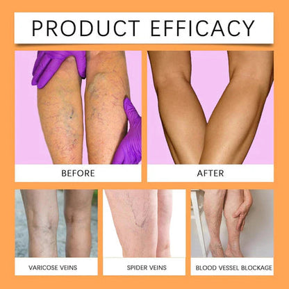 🌿 Varicose Vein Relief Spray – Soothing Comfort in Every Spray! 💧