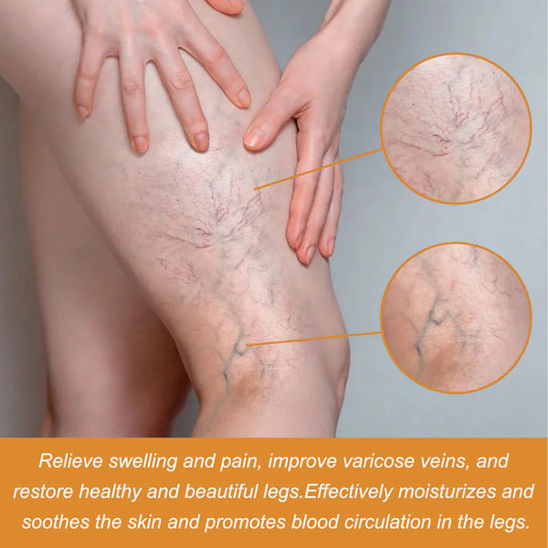 🌿 Varicose Vein Relief Spray – Soothing Comfort in Every Spray! 💧