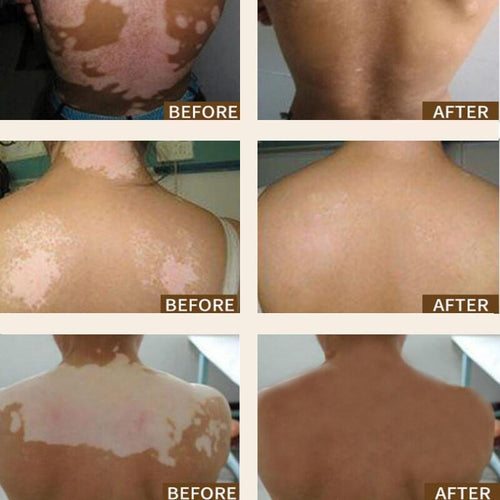 Sumifun Vitiligo Treatment Cream (BUY 1 GET 1 FREE)